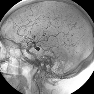 Clot Removing Devices Provide Better Outcomes For Stroke Survivors American Heart Association Clot Removing Devices Provide Better Outcomes For Stroke Survivors American Heart Association