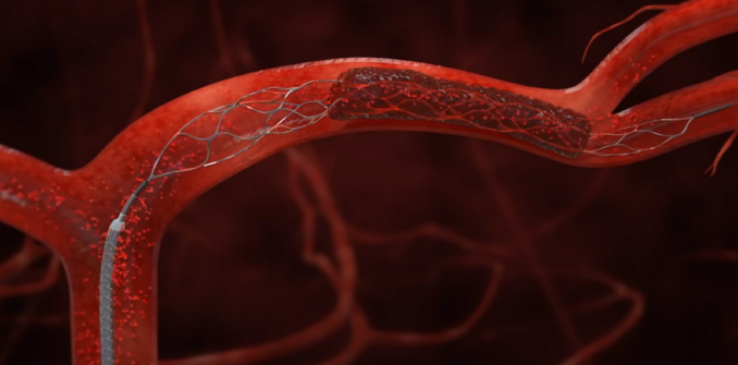 Illustration of a stent inside an artery