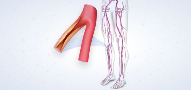 Vascular disease illustration