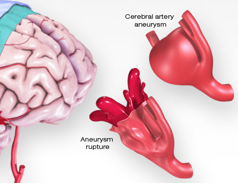 define aneurysm medical
