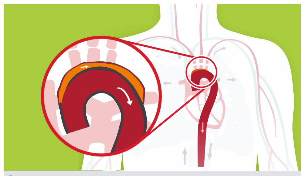 medical illustration of an aorta
