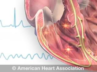 Arrhythmia: Symptoms & Treatment