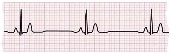 Bradycardia: Slow Heart Rate