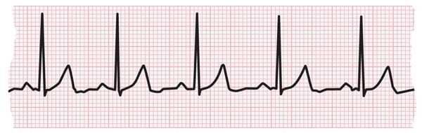 ECG strip showing normal heartbeat