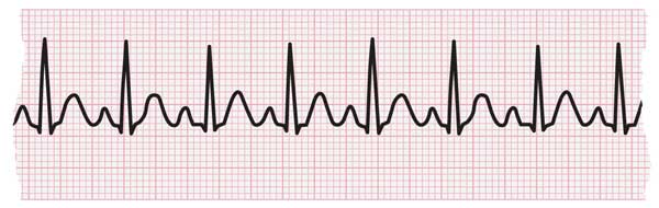 Tachycardia: Fast Heart Rate