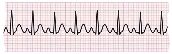 can high blood pressure cause rapid heartbeat)