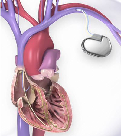 ICD and heart