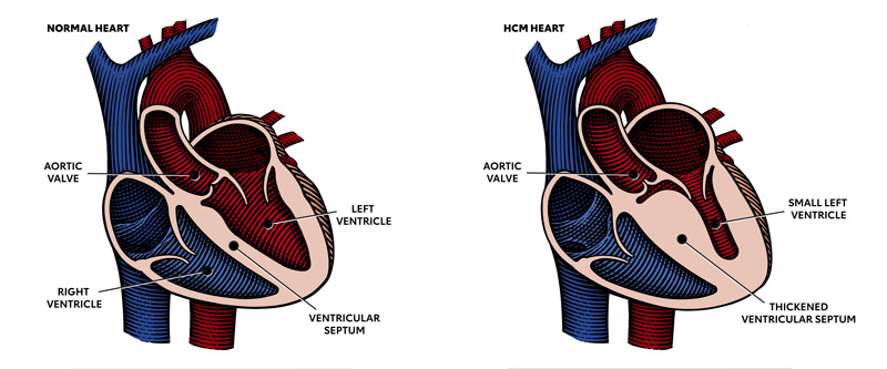 Hypertrophic Cardiomyopathy Hcm American Heart Association