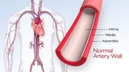 What Is Atherosclerosis American Heart Association