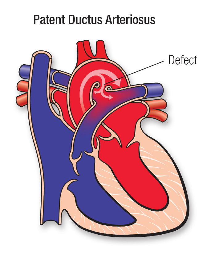 Fetal Ductus Arteriosus