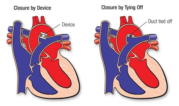 PDA repairs diagram