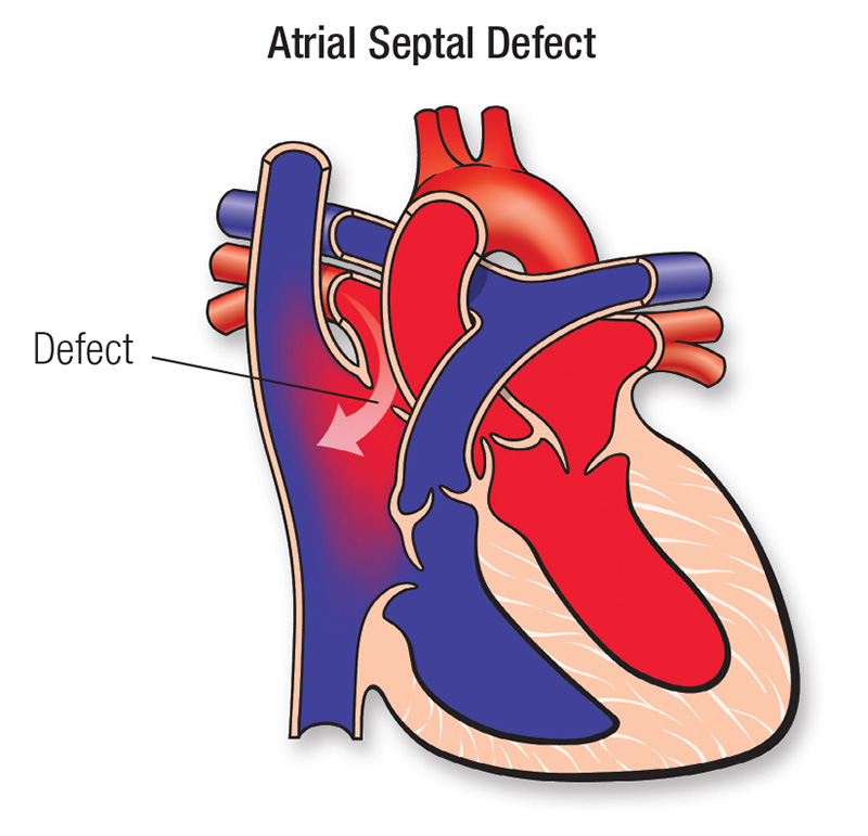 Atrial Septal Defect (ASD) | American Heart Association