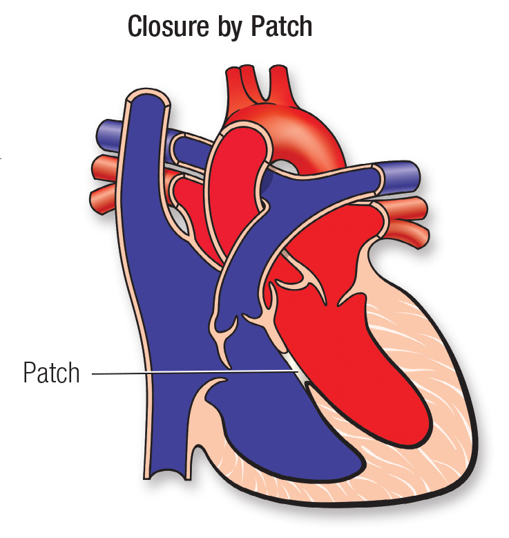 heart with a closure by patch