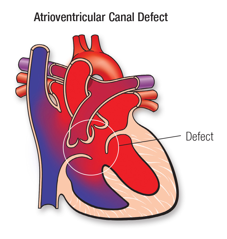 atrioventricular canal defect