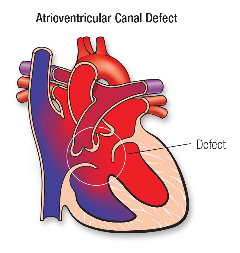 Atrioventricular canal defect