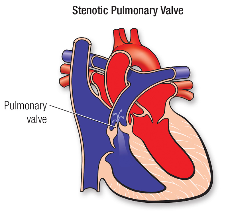 pulmonary stenosis diagram