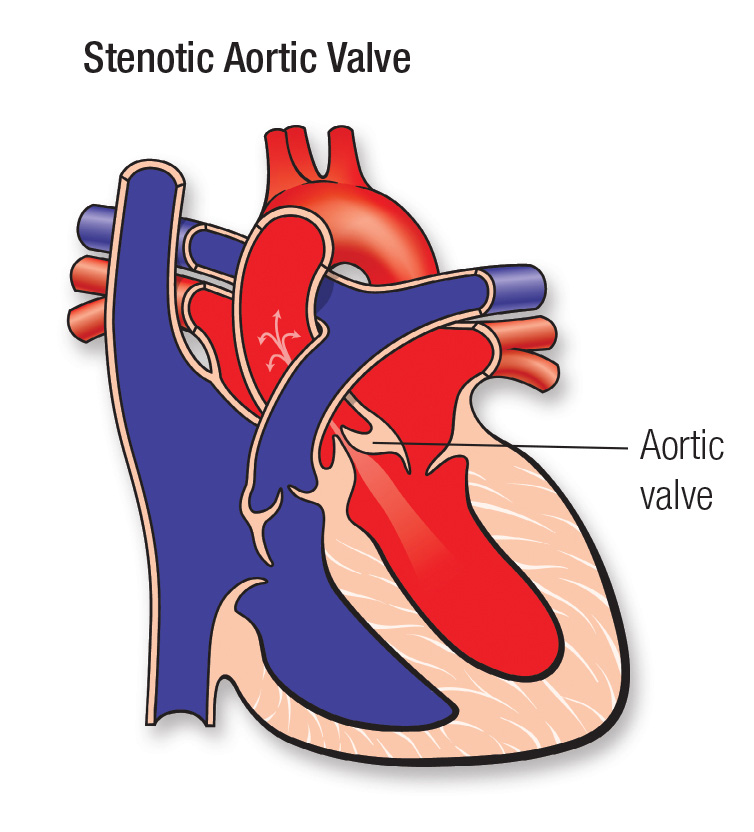 stenotic aortic valve