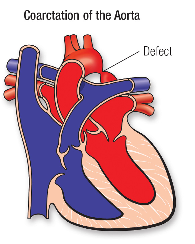 Coarctation of the aorta