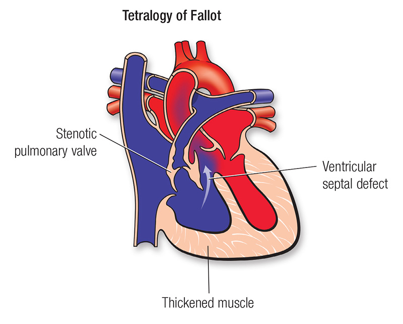 a heart with tetralogy of Fallot