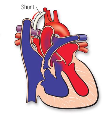 Tetralogy of Fallot shunt diagram