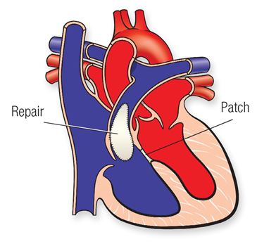 Tetralogy of Fallot patch diagram