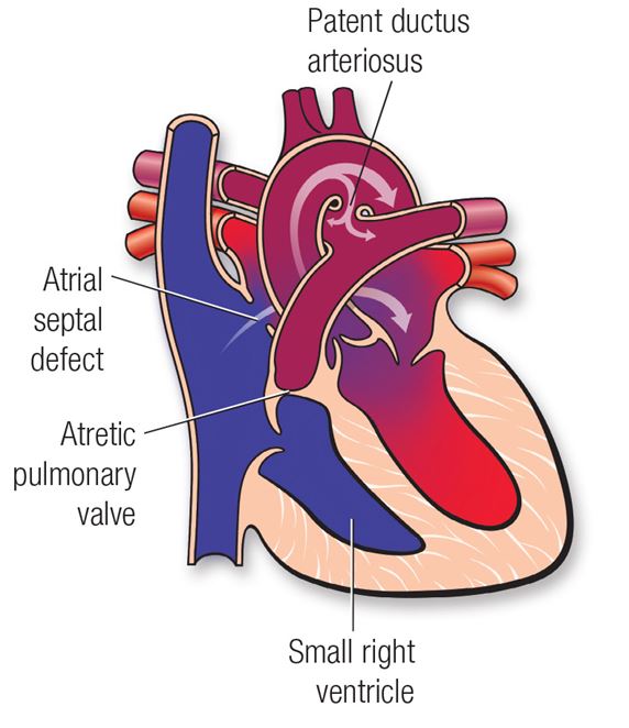 Diagrama de la atresia pulmonar