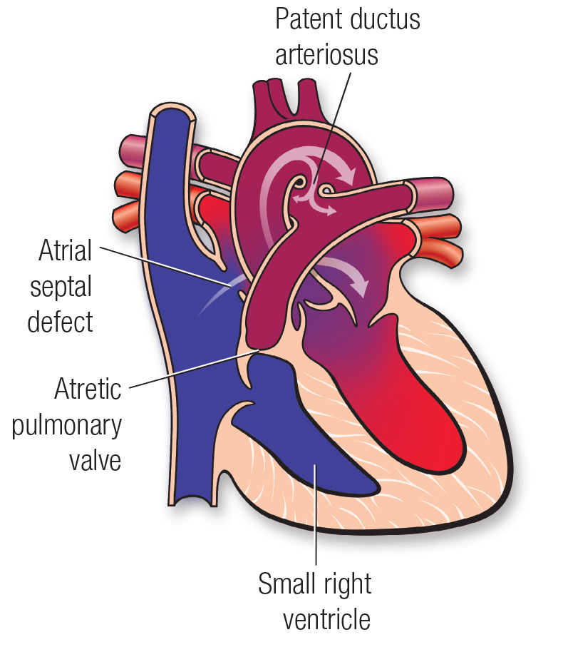 Pulmonary atresia diagram
