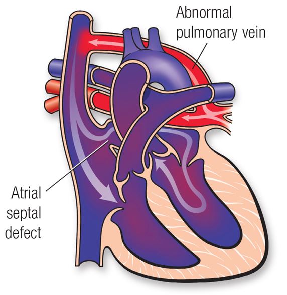 Total Anomalous Pulmonary Venous Connection (TAPVC) | American Heart  Association