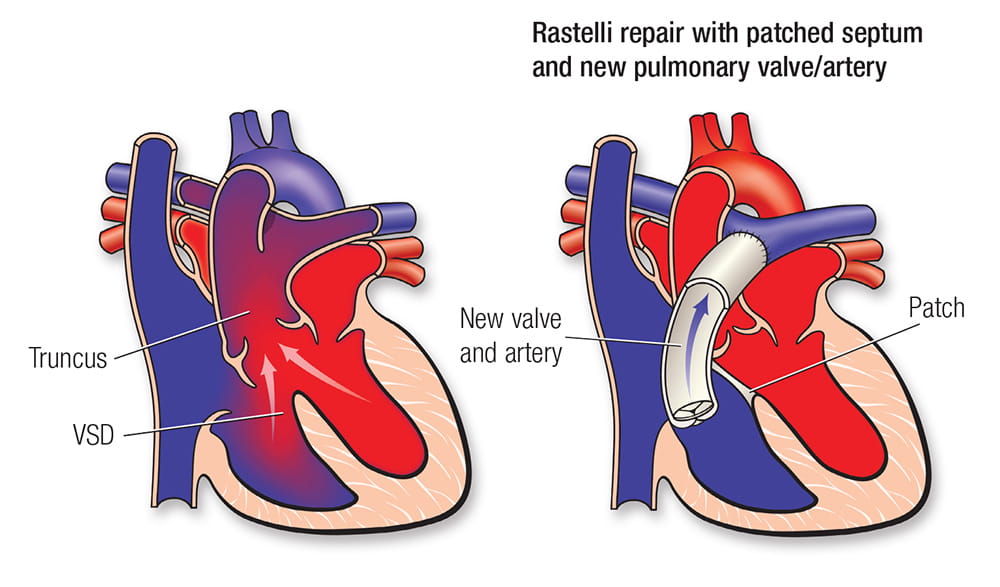 a heart with a rastelli repair