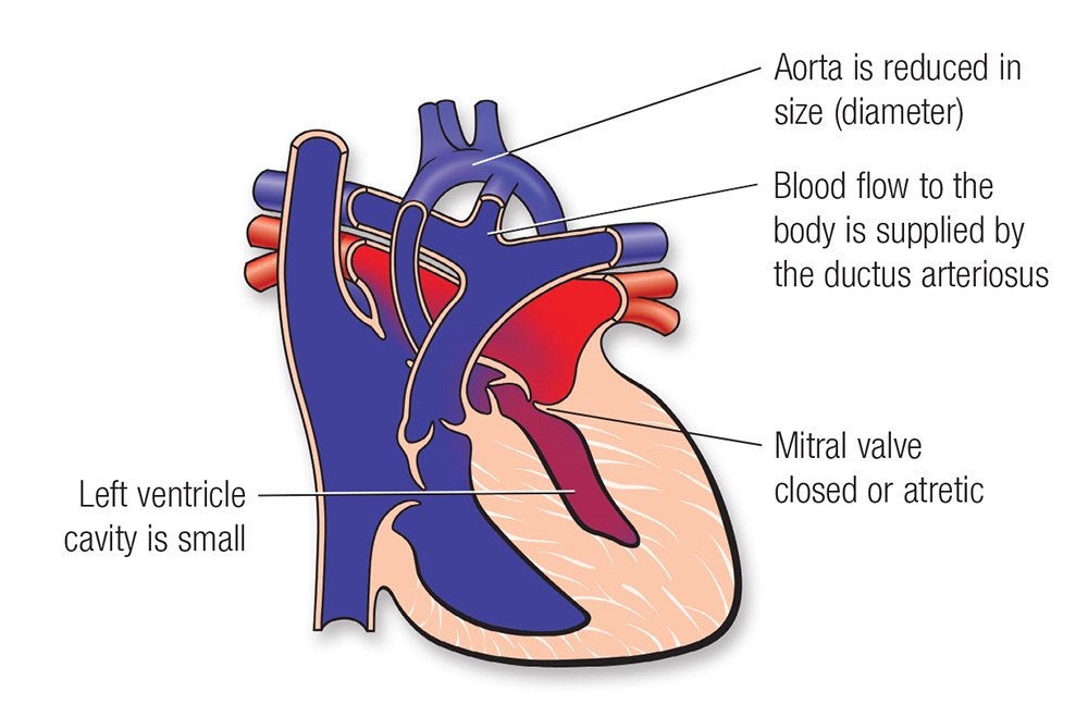 A heart with HLHS