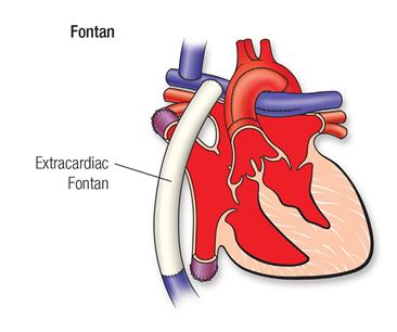 Diagrama de reparación de Fontan