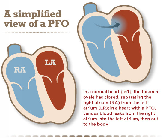 A simplified view of a PFO