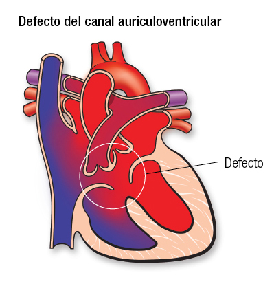 AV Canal Defect SP