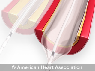 illustration of angioplasty