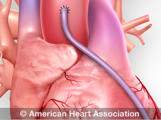 toekomst Op grote schaal hurken Heart Procedures and Surgeries | American Heart Association