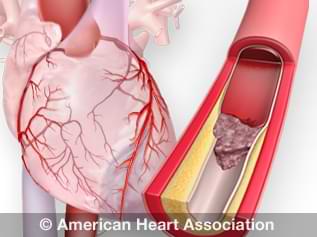 What is a Heart Attack? | American Heart Association