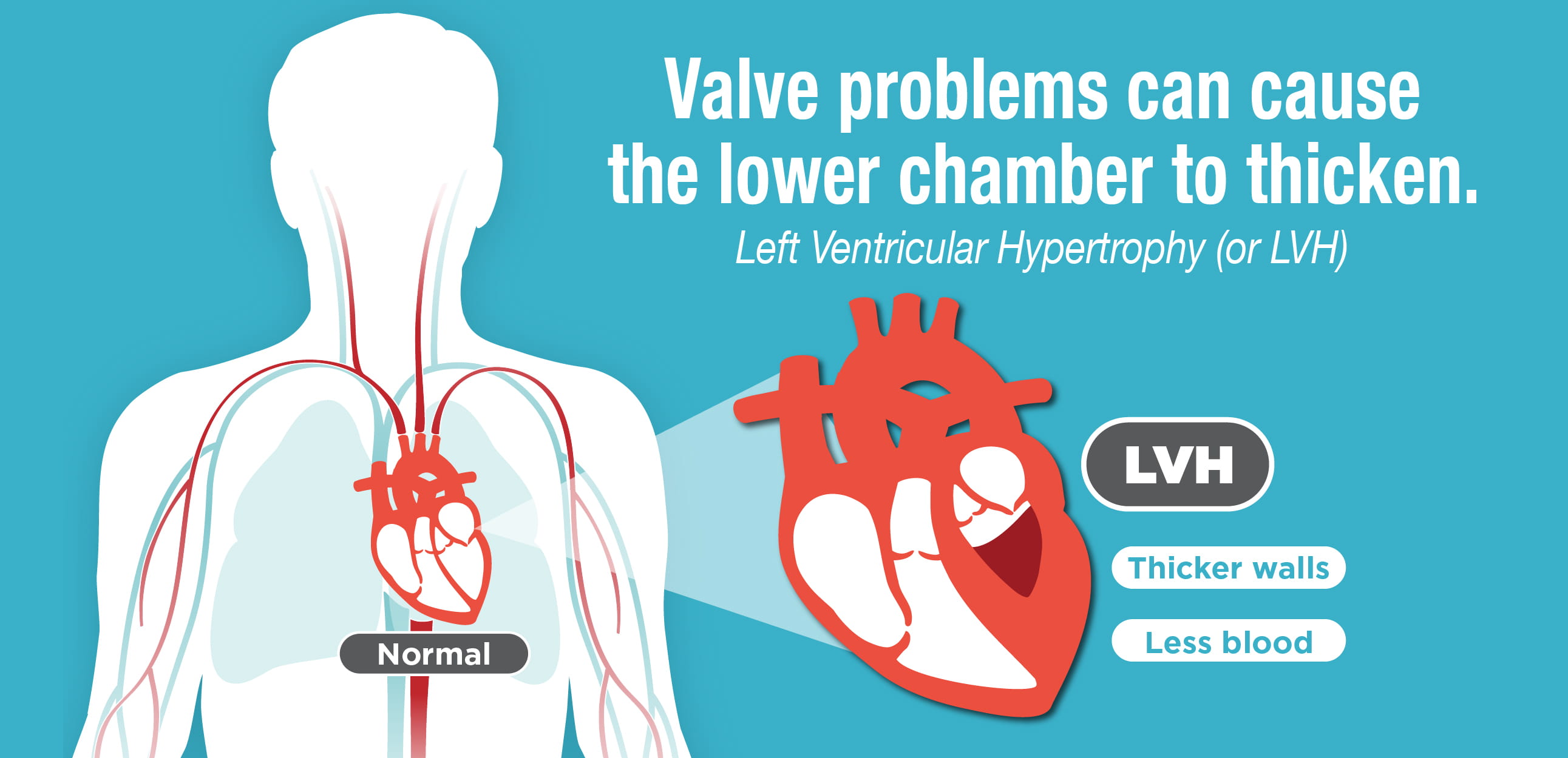 Left Ventricular Hypertrophy (LVH): Causes, Symptoms and Treatment