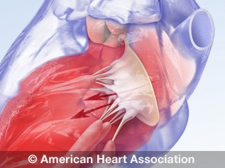 Problem: Mitral Valve Stenosis | American Heart Association