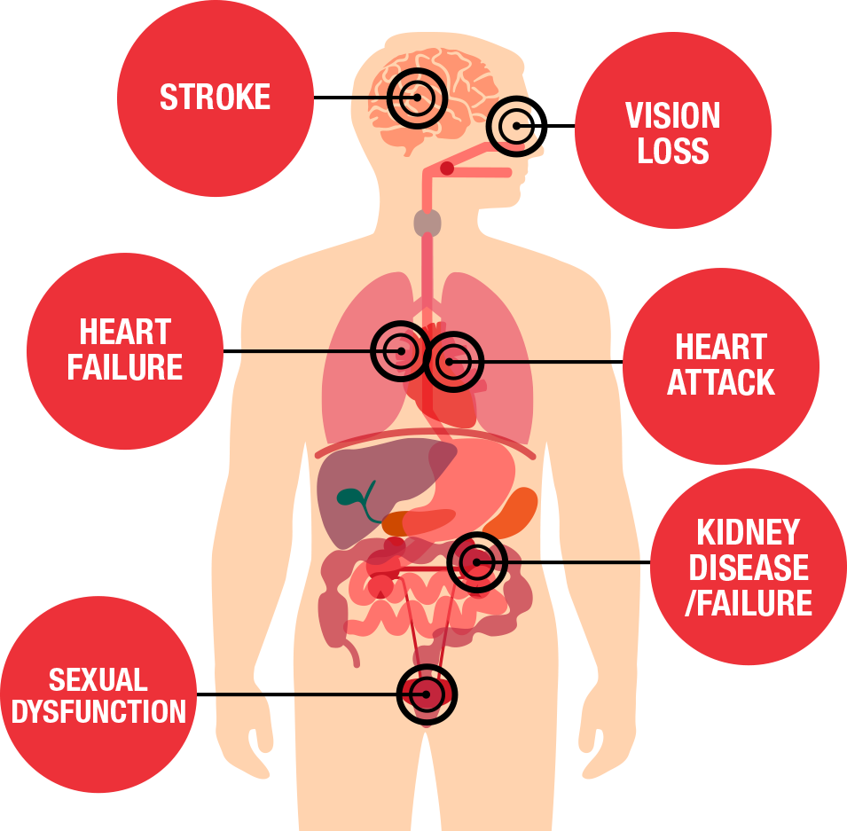 High Blood Pressure: Causes and Symptoms - PSRI Hospital