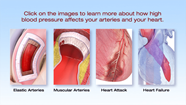 What Is High Blood Pressure American Heart Association