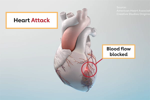 The differences between heart attack and cardiac arrest video screenshot