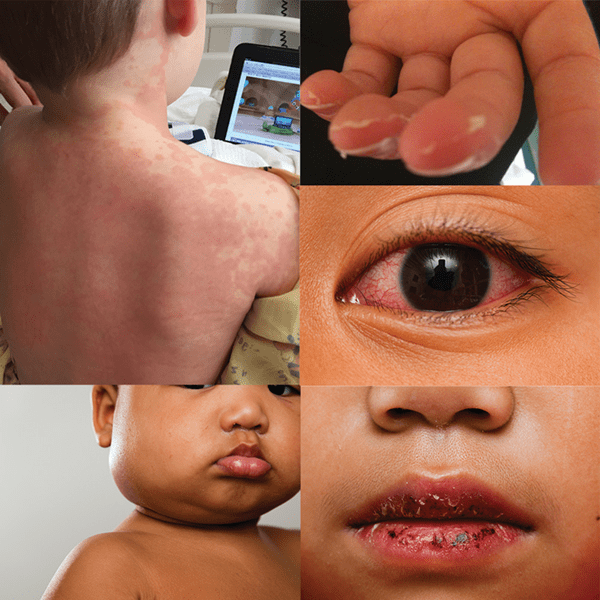 Bøde mærke navn Jeg klager Kawasaki Disease: Signs, Symptoms and Diagnosis | American Heart Association