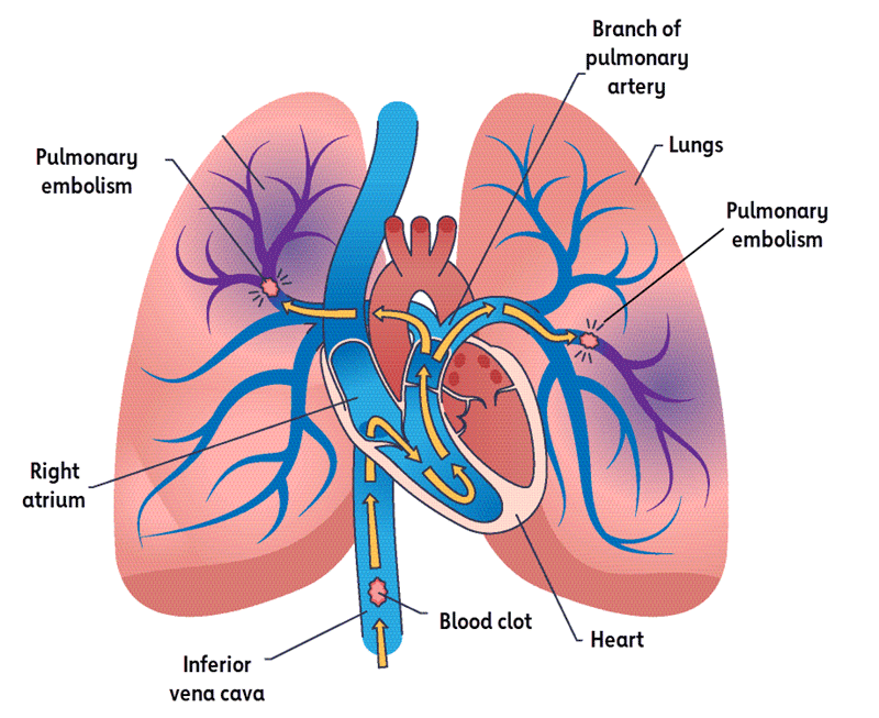 Illustration of heart and lungs showing a pulmonary embolism