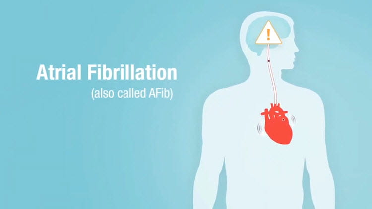 Learn about AFib video