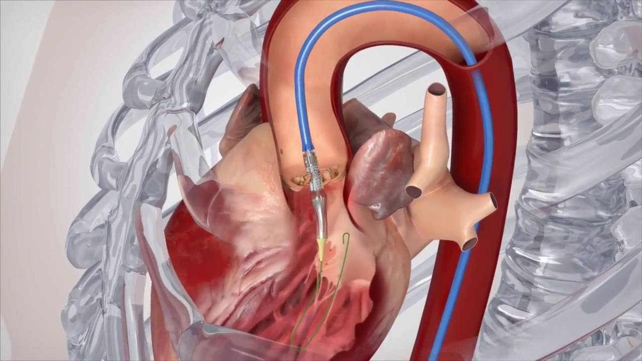 Factors Affecting Recovery from Heart Valve Surgery video screenshot