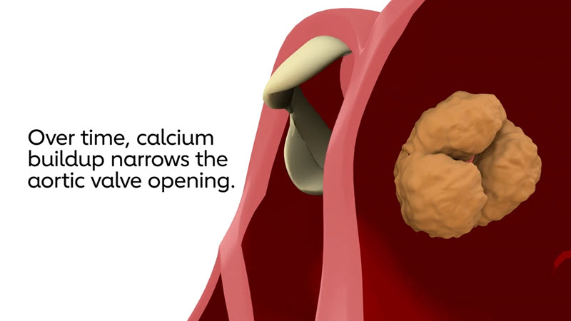Root canal infection process. 3D Animati, Stock Video