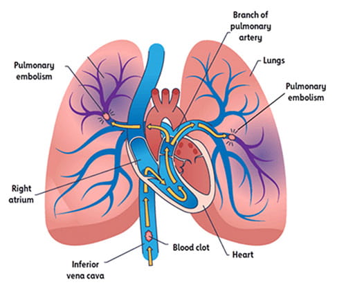 What is Pulmonary Embolism graphic