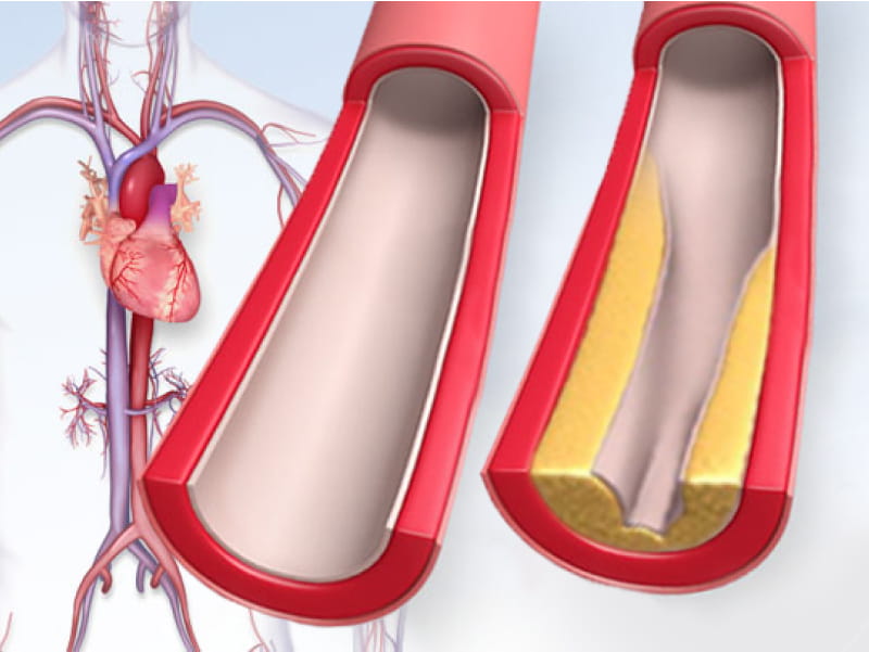 Cholesterol buildup inside artery