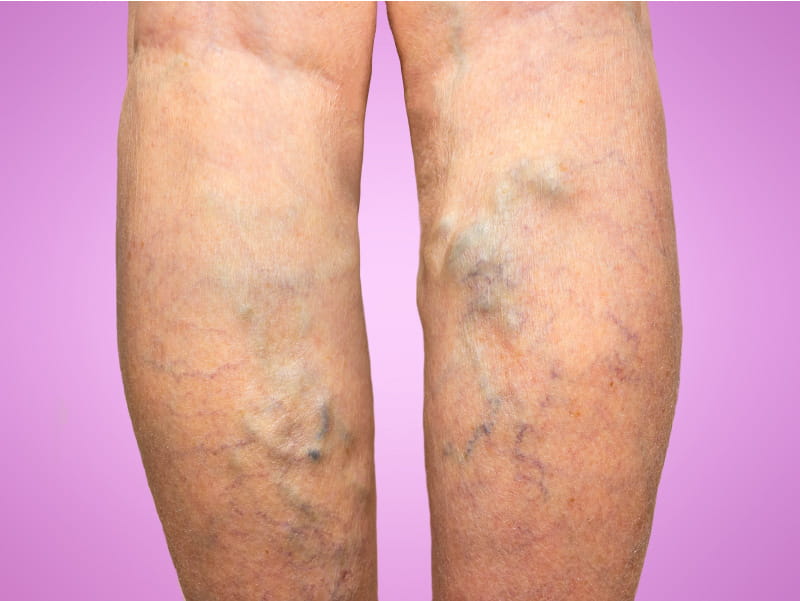 Legs with varicose veins. (Marina113/Getty Images)