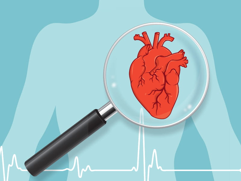 Clogged arteries are not the only sign of cardiovascular disease | American  Heart Association